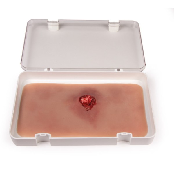 Wundmoulage ERLER-ZIMMER, Offener Bruch