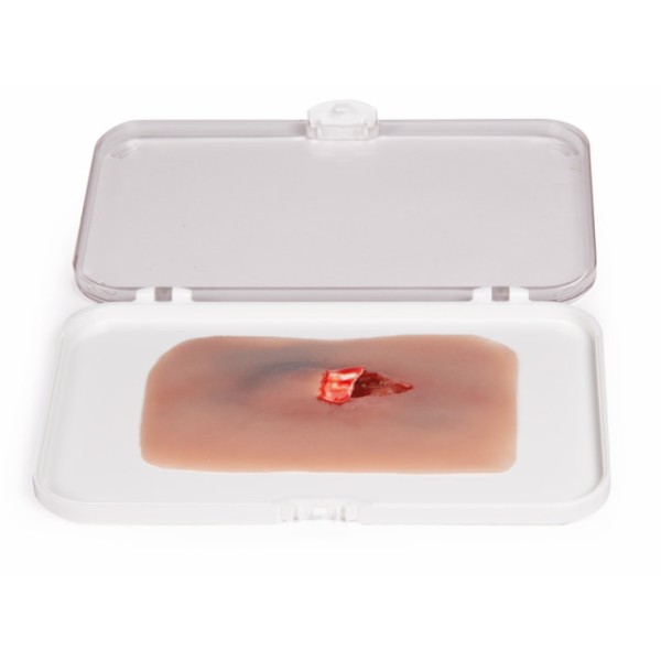 Wundmoulage ERLER-ZIMMER, offener