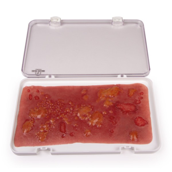 Wundmoulage ERLER-ZIMMER, Verbrennung