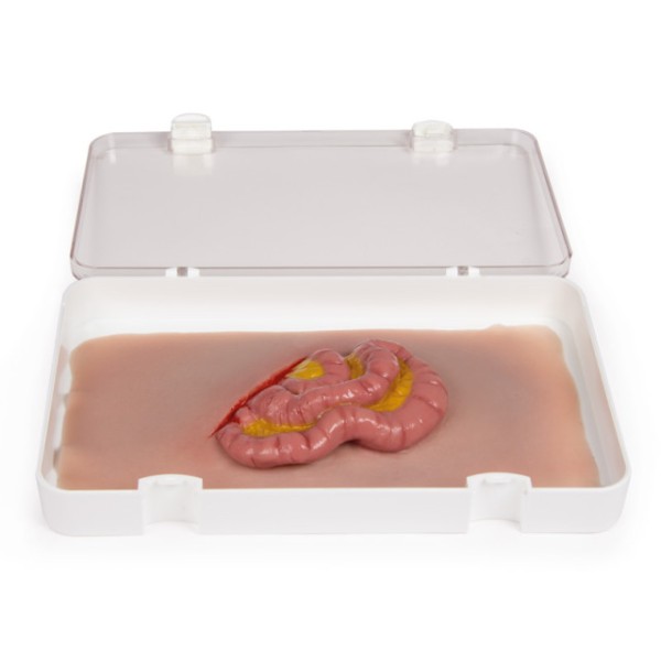Wundmoulage ERLER-ZIMMER, austretender