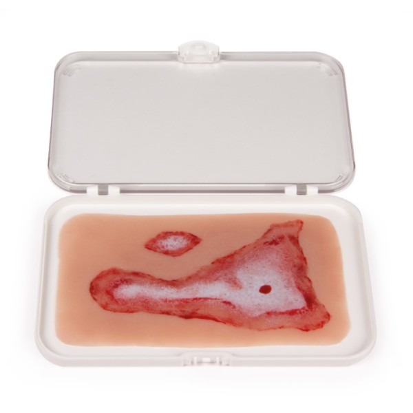 Wundmoulage ERLER-ZIMMER, Verbrühung